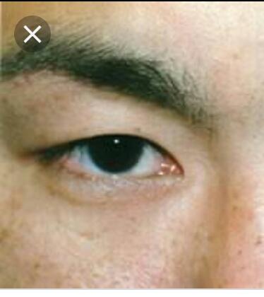 Single eyelid or double eyelid which is attractive?