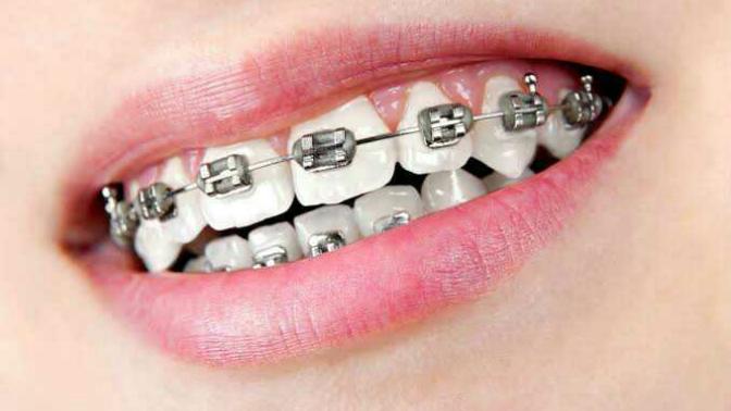 Girls, what do you think if guys use Teeth Braces for their teeth? Is it looks ugly?