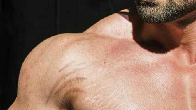 How to get rid of stretch marks?