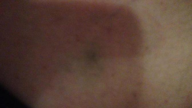Is this a broken blood vessel or a bruise?
