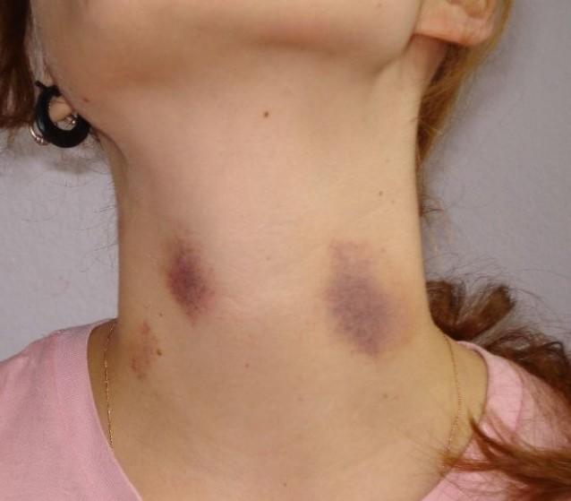 Why do guys give hickeys?