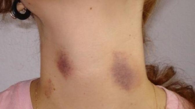 Why do guys give hickeys?