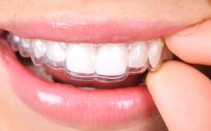 My Invisalign braces cracked! What should I do?