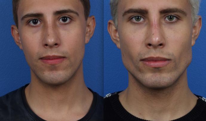 Jaw Augmentation