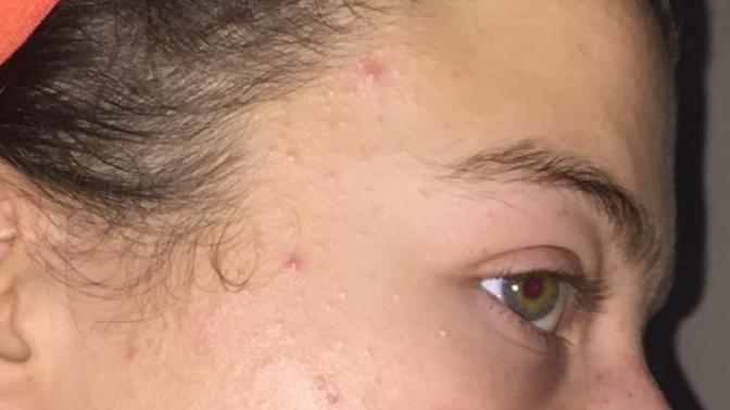 Why is my skin not getting better?