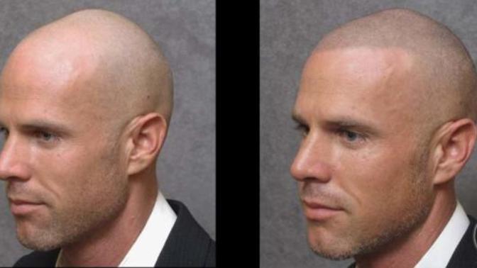 What do you think of Scalp MicroPigmentation (SMP)?