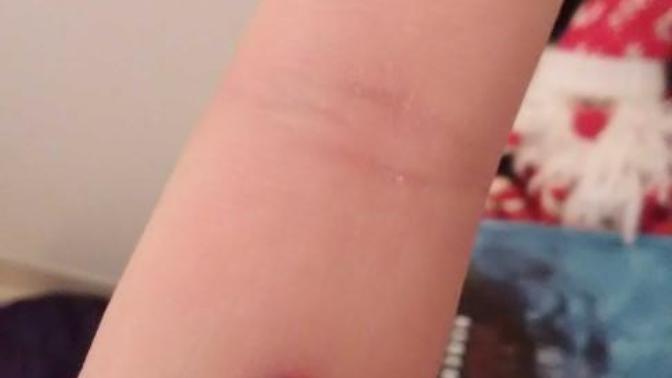 I found this on my finger, how bad is gaggers, will I make till Christmas, has alien implanted himself in my skin?