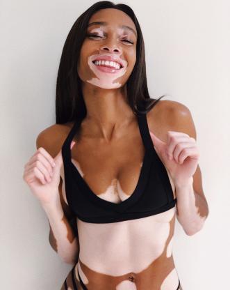 Would you date someone with vitiligo?
