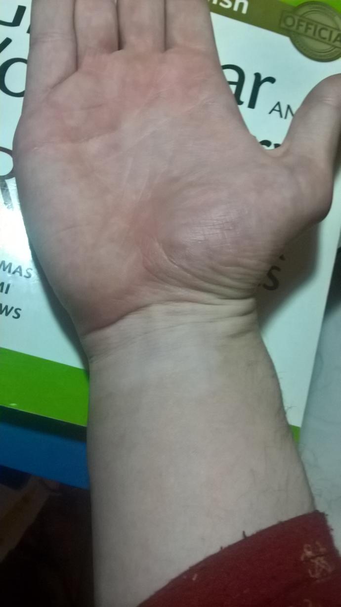 Would you date someone with vitiligo?