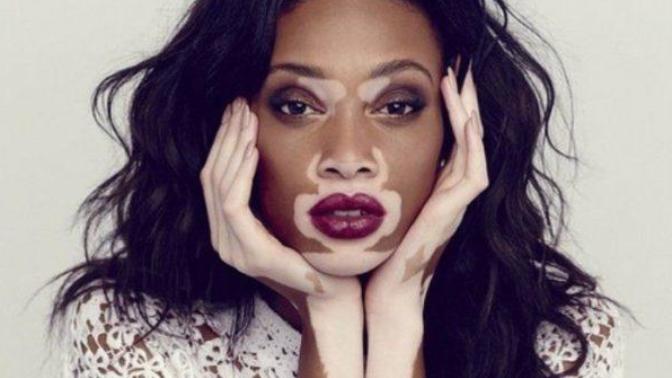 Would you date someone with vitiligo?