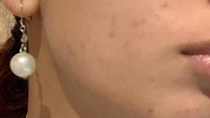 Please help? Are these acne scars? How do I get rid of them?