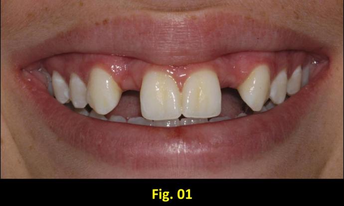 Imagine there are metal braces on top of the teeth.