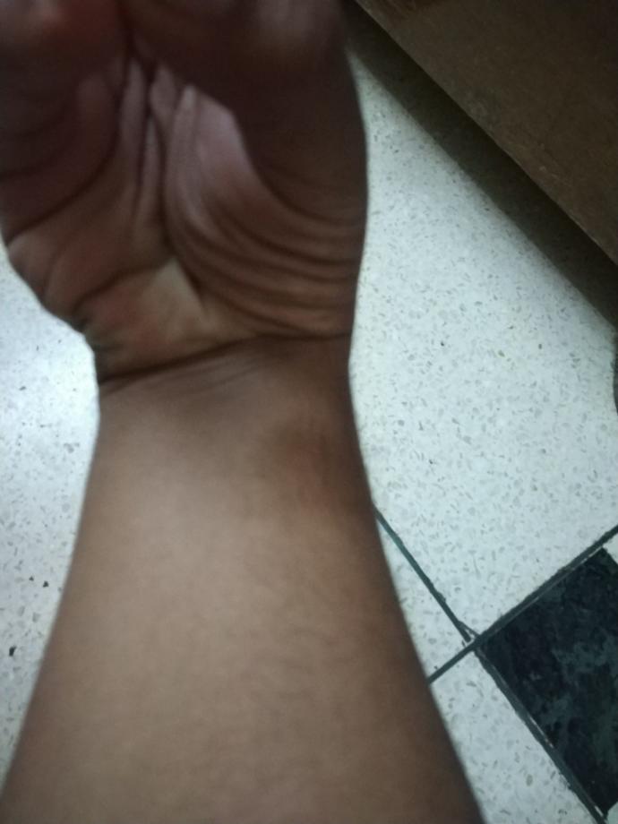 Are you missing your Palmaris Longus Muscles?