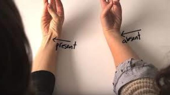 Are you missing your Palmaris Longus Muscles?