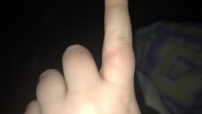 Is my finger broken?