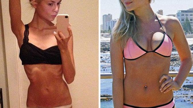 ANOREXIA! Is this a sure path to suicide?