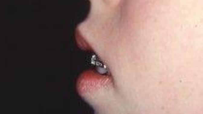 Is a short upper lip very unattractive (meaning teeth show in rest position and gums show when smiling)?