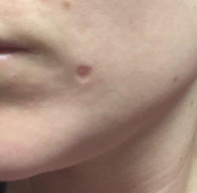 What is worse a scar or mole (be honest)?