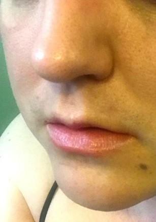 What is worse a scar or mole (be honest)?