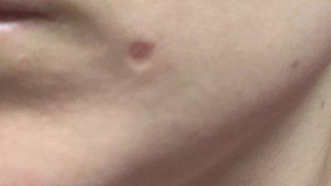 What is worse a scar or mole (be honest)?