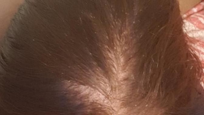 Help. I'm suffering from hair loss. What do I do?