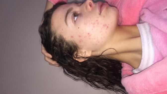Does anyone know any effective proven acne treatments?
