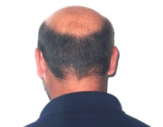 Balding : when is it time for a razor?