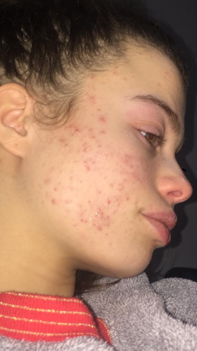 Do I have moderate or severe acne?
