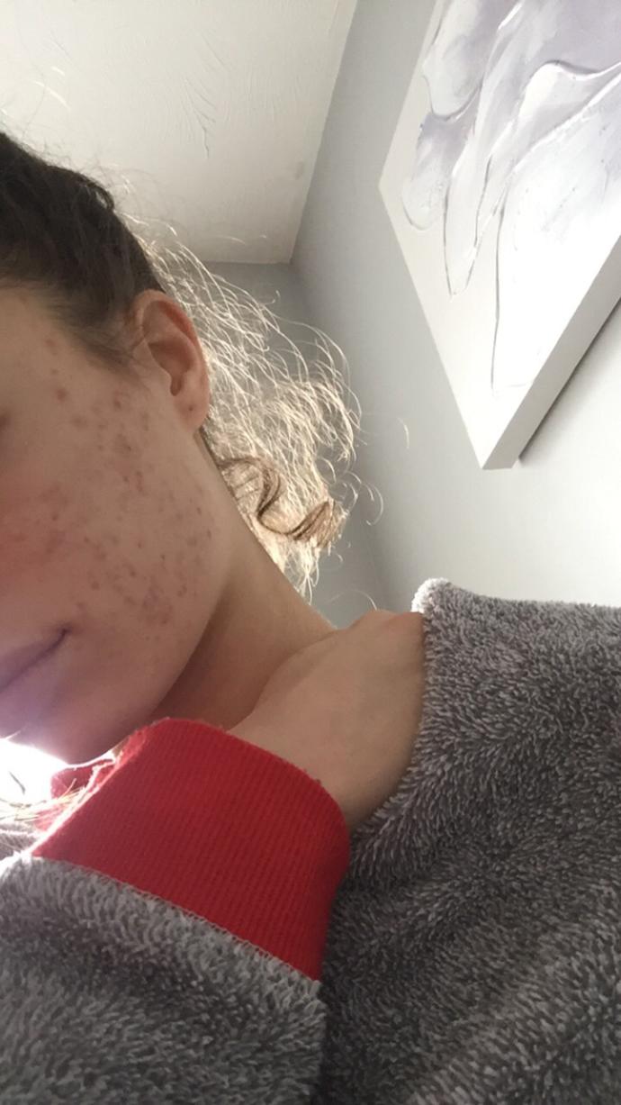Do I have moderate or severe acne?