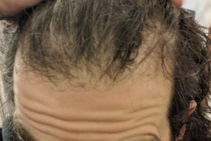 Lord am effected by a bald patch