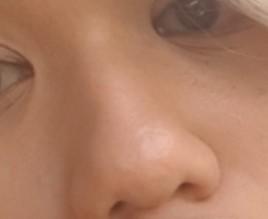 Should I get a nose job?