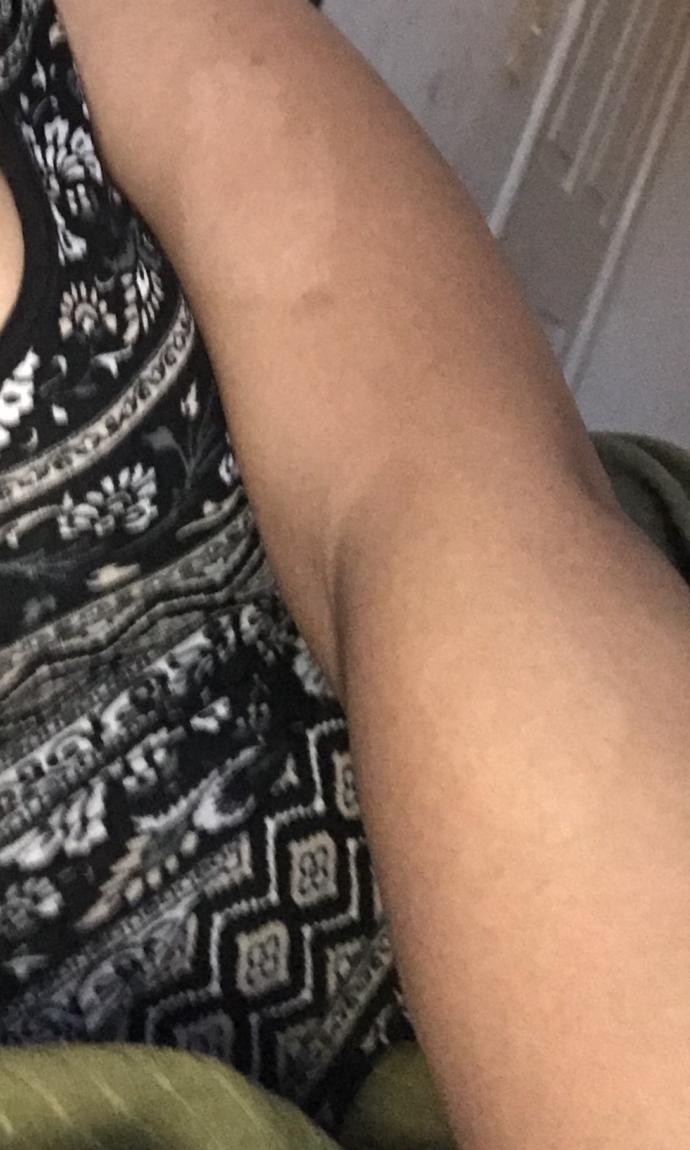 Why did another white patch on the bottom of my arm appear?