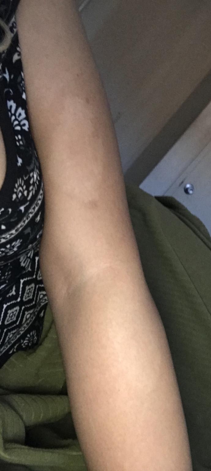 Why did another white patch on the bottom of my arm appear?