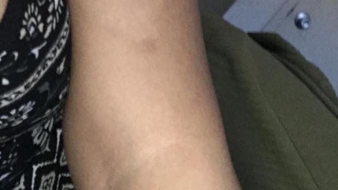 Why did another white patch on the bottom of my arm appear?