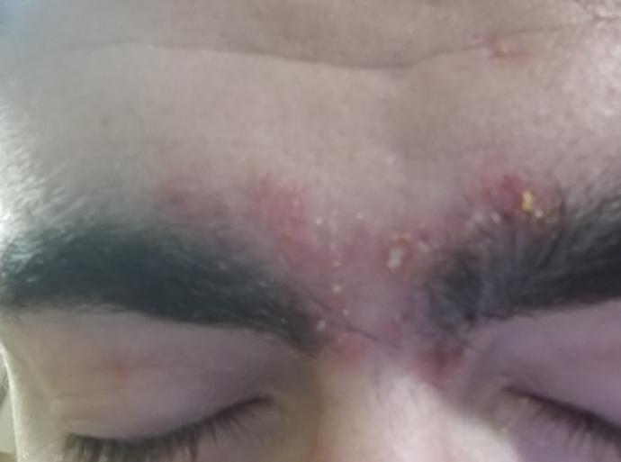 How can I get rid of sucking dandruff problem?