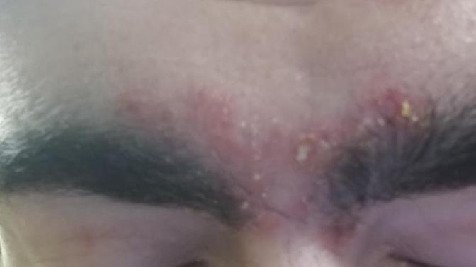 How can I get rid of sucking dandruff problem?