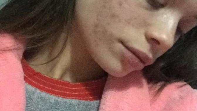 Does anyone else suffer from acne? and what medication/treatments are you taking?