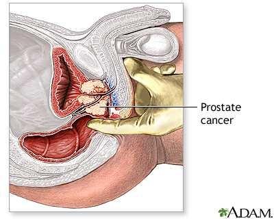 Isn't it weird that the doctor has to pop you in the butt every year to check for prostate cancer?
