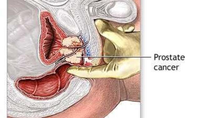 Isn't it weird that the doctor has to pop you in the butt every year to check for prostate cancer?