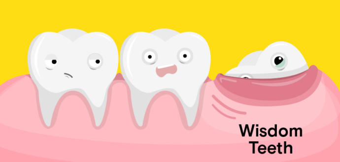Do you still have your wisdom teeth, or have you already had them