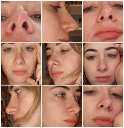Is my nose that bad? Should I get a revision rhinoplasty?