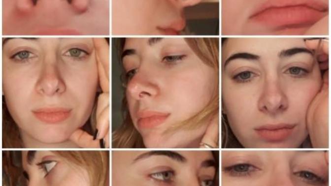 Is my nose that bad? Should I get a revision rhinoplasty?