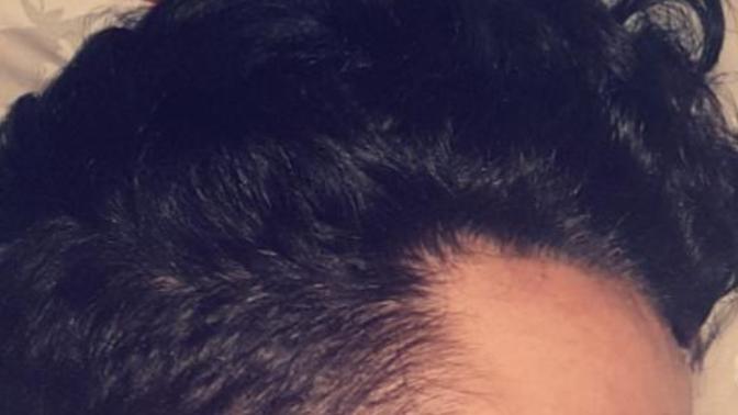 Is this a MATURE hairline OR reversing Hairline and am I going BALD?