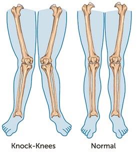 Anyone had leg correction surgery caused by knock knee?