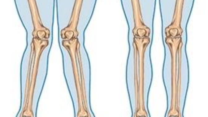 Anyone had leg correction surgery caused by knock knee?