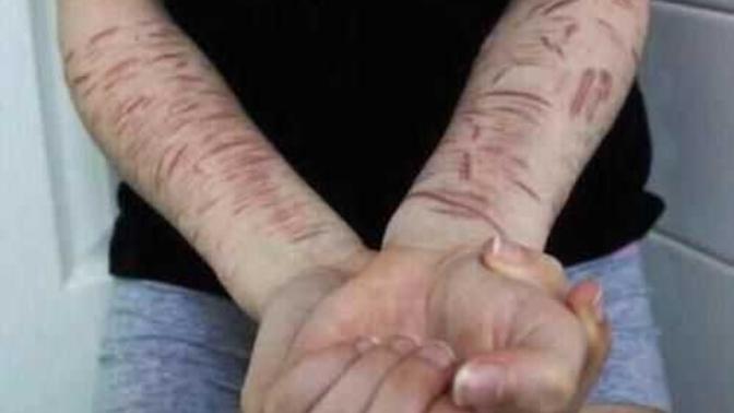 What is your opinion of people who self harm?