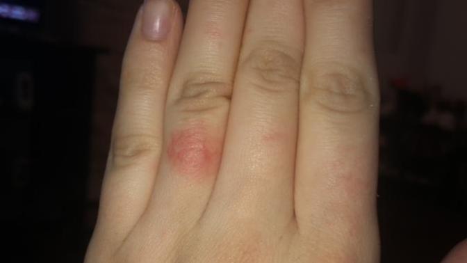 What’s wrong with my finger / fingers? They are red painful and itchy?