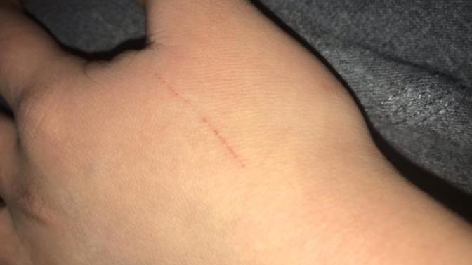 Can you still get sick from a small scratch on a piece of rusty metal?