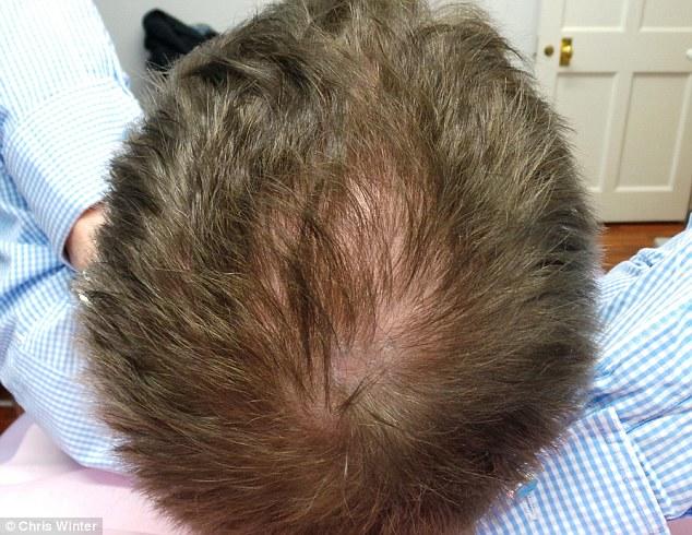 Does anybody else have a NATURALLY thin crown?