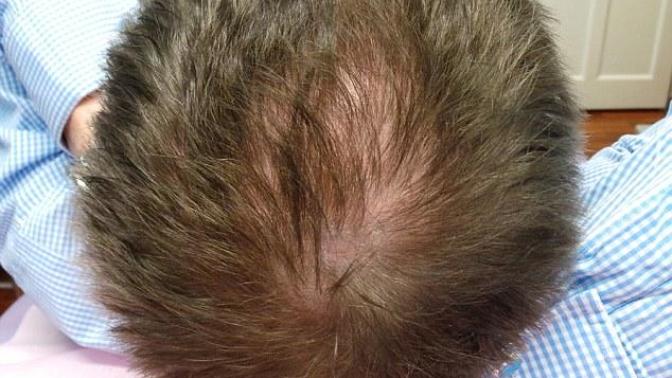 Does anybody else have a NATURALLY thin crown?